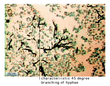 lung aspergillosis