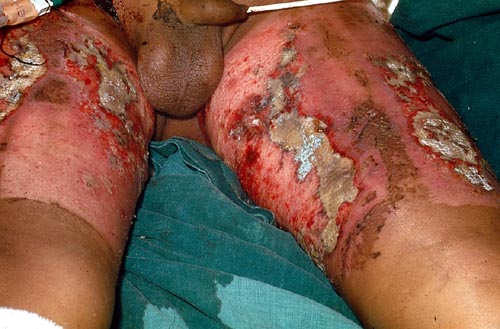 Aspergillus sp. Infection of burn wound 