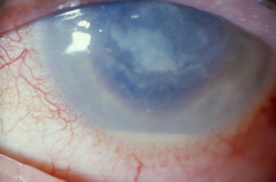 Aspergillus Keratitis