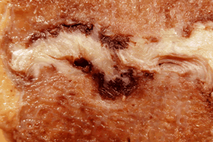 lesion of a lumbar intervertebral vertebral