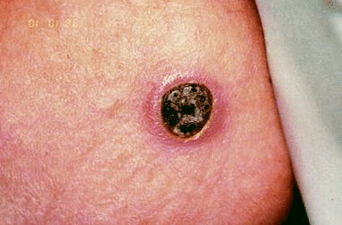 primary cutaneous  aspergillosis lesion buttocks area