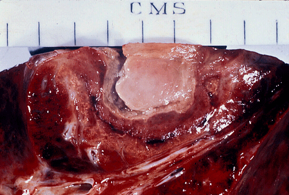 Aspergillosis of lungs