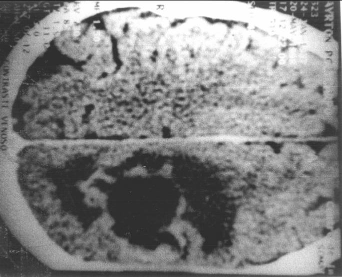 Brain abcess due to Claophilaphora bantiana